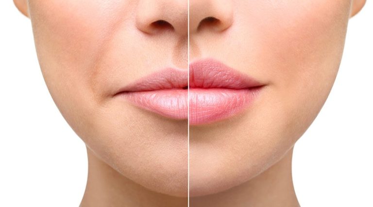 Dermal Fillers in Dubai